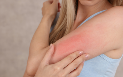 Conquer Itchy, Irritated Skin: Skin Allergy Treatment in Hazlet, NJ