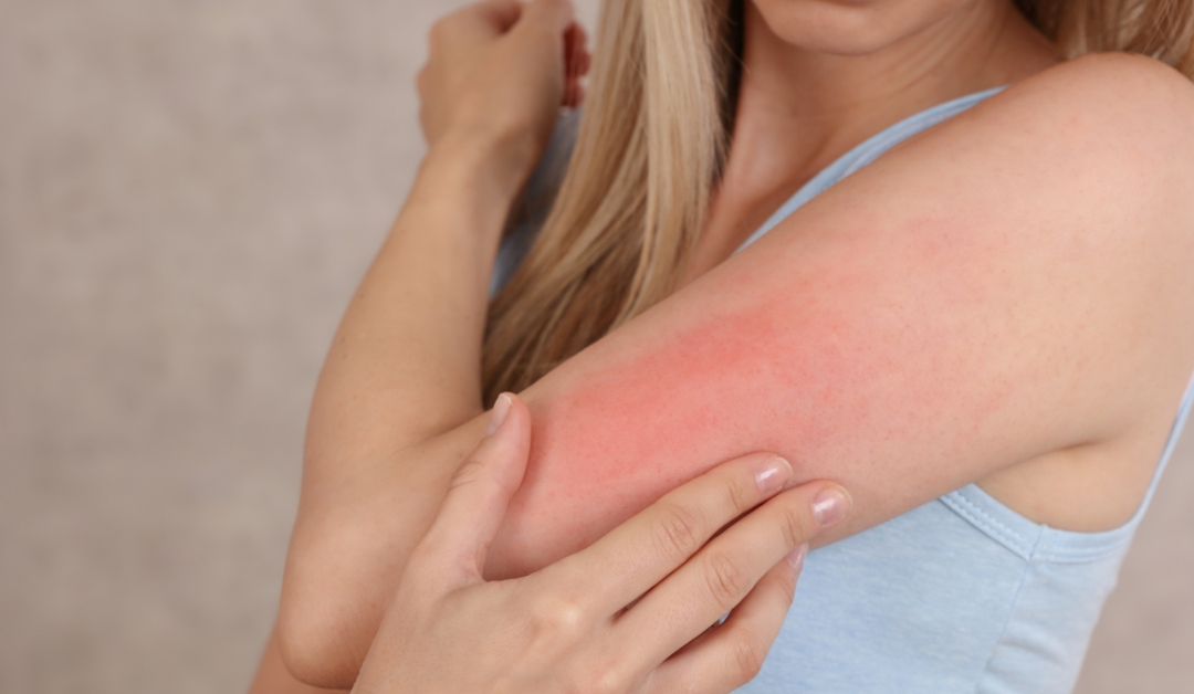 Conquer Itchy, Irritated Skin: Skin Allergy Treatment in Hazlet, NJ